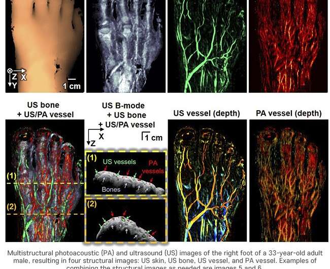 3D bimodal photoacoustic ultrasound imaging to diagnose peripheral vascular diseases