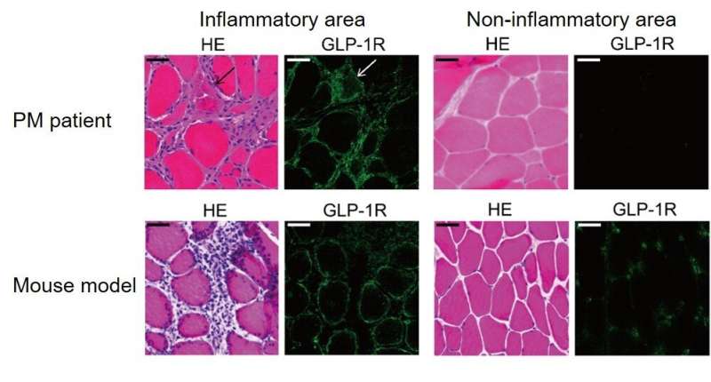 A novel drug suppresses muscle inflammation and restores muscle weakness