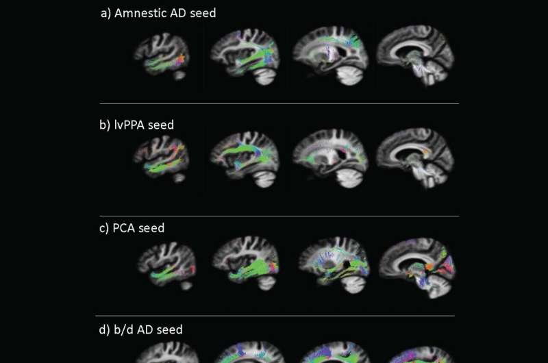 A telltale protein spreads throughout the brain in distinct patterns based on patients' Alzheimer's phenotype