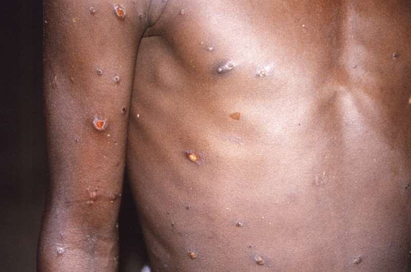 Africans see inequity in monkeypox response elsewhere