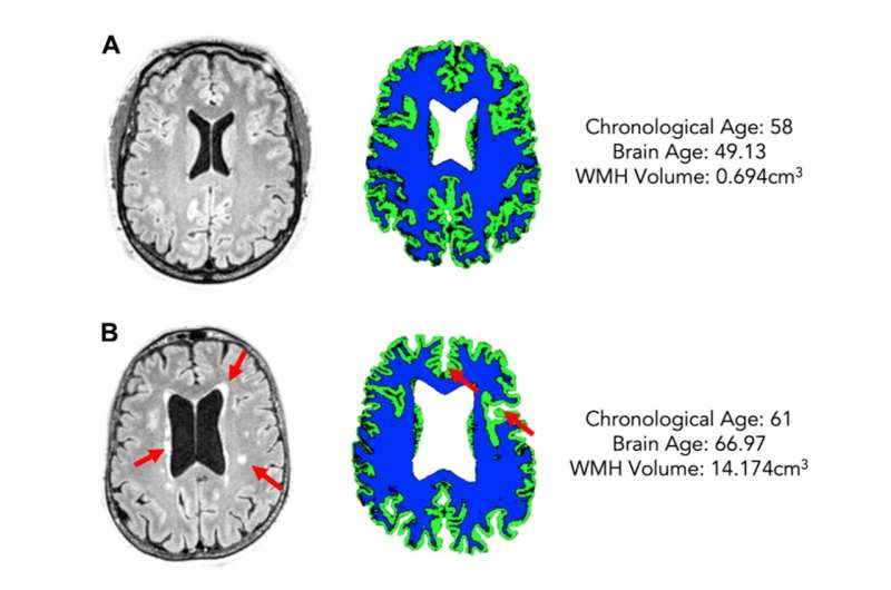 Aging | White matter hyperintensity load is associated with premature brain aging