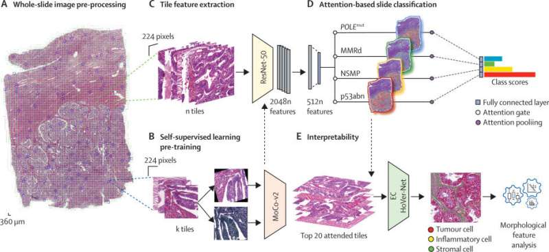The application of artificial intelligence in pathology reveals new insights into endometrial cancer diagnostics