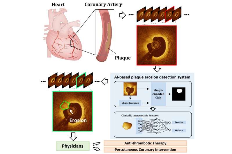 AI-Based Image Analysis Automatically Detects Serious Heart Condition | News Releases