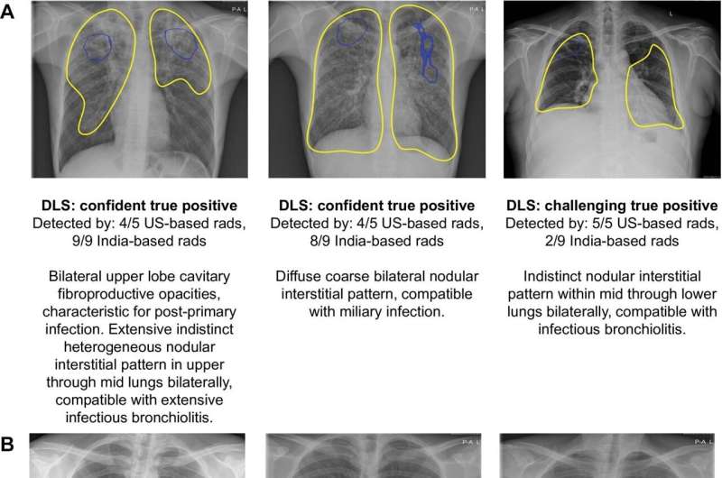 AI-based system shows promise in tuberculosis detection