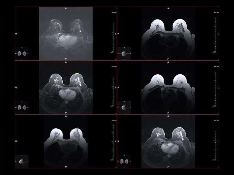 AI could improve diagnostic accuracy of breast DCE-MRI