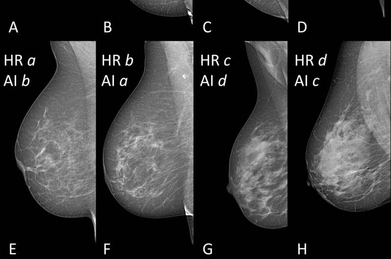 AI provides accurate breast density classification