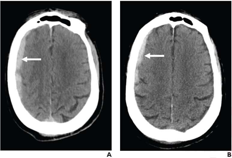 Antithrombotic therapy unassociated with intracranial hemorrhage after fall