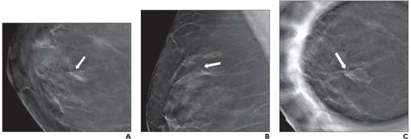Architectural distortion on digital breast tomosynthesis with nonmalignant pathology