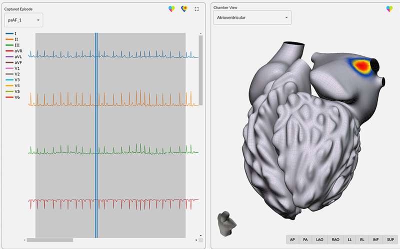 Arrhythmia Mapping Technology Demonstrates Positive Clinical Results