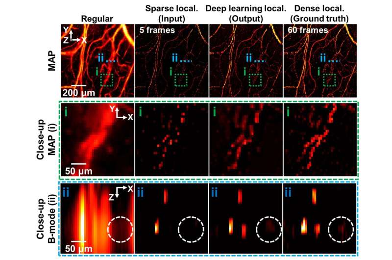 Artificial intelligence technology accelerates super-resolution localization photoacoustic imaging of blood vessels