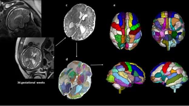 Autism-associated brain differences can be observed in the womb