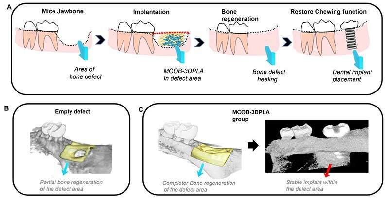 Bone transplant could resolve aging jaw defects