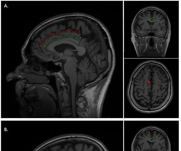 Brain folds formed during foetal stage could affect onset of dementia