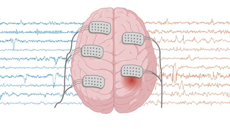 Brain signal irregularity may provide clues to understanding epileptic process