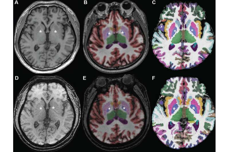Brain volume and memory impairment: conventional vs ultrafast 3D MRI sequences