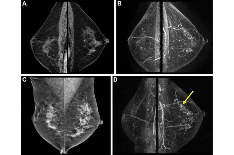 Breast MRI illuminates risk of second breast cancer