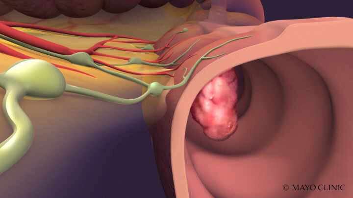 Can colorectal cancer be prevented?