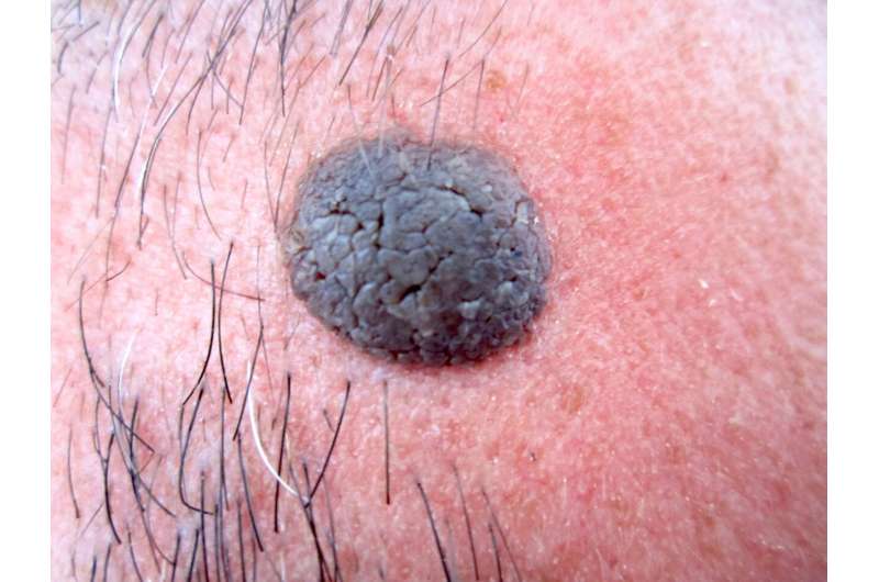 Check moles during Skin Cancer Awareness Month