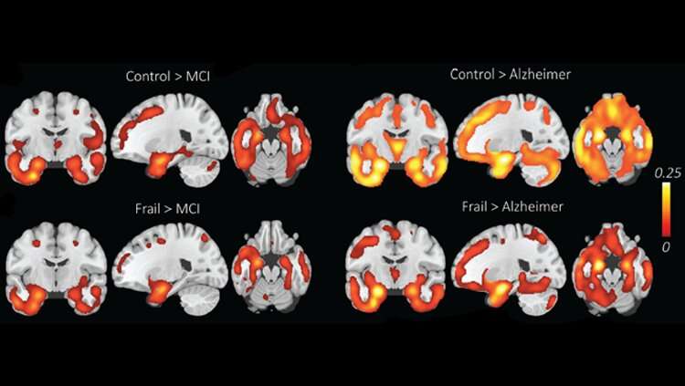 Cognitive decline not always a sign of Alzheimer's disease
