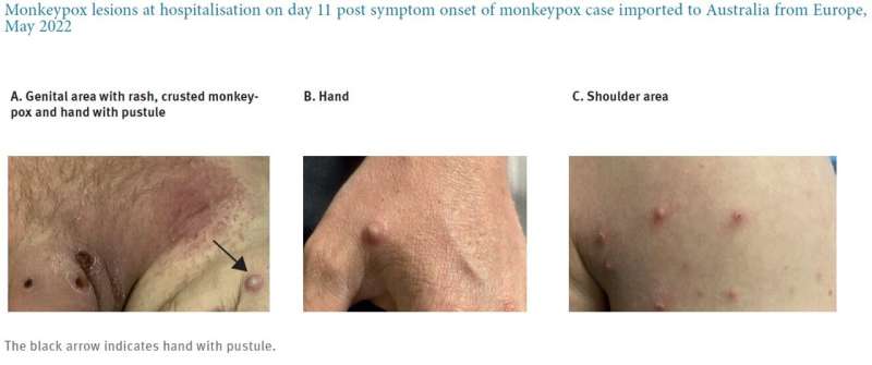 Community transmission of monkeypox