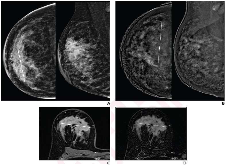 Contrast-enhanced mammography vs. MRI: Neoadjuvant therapy response in breast cancer