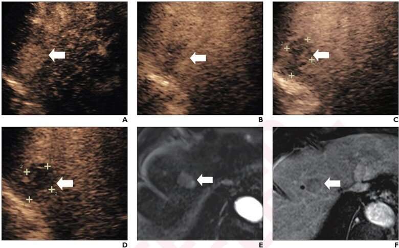 Contrast-enhanced ultrasound, perfluorobutane diagnoses high-risk hepatocellular carcinoma