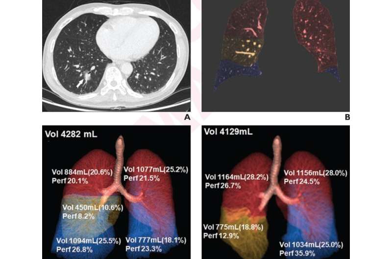 DECT assesses postoperative lung volume, perfusion changes