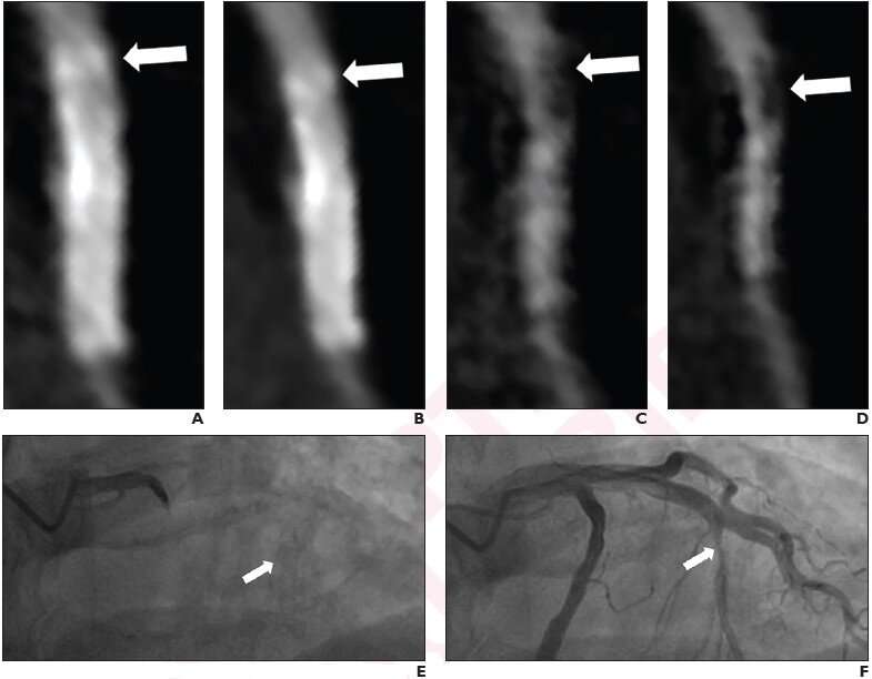 Deep Learning, Subtraction Technique Optimal for Coronary Stent Evaluation by CTA