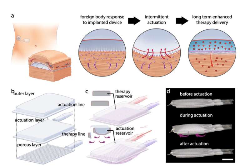 Design prevents buildup of scar tissue around medical implants
