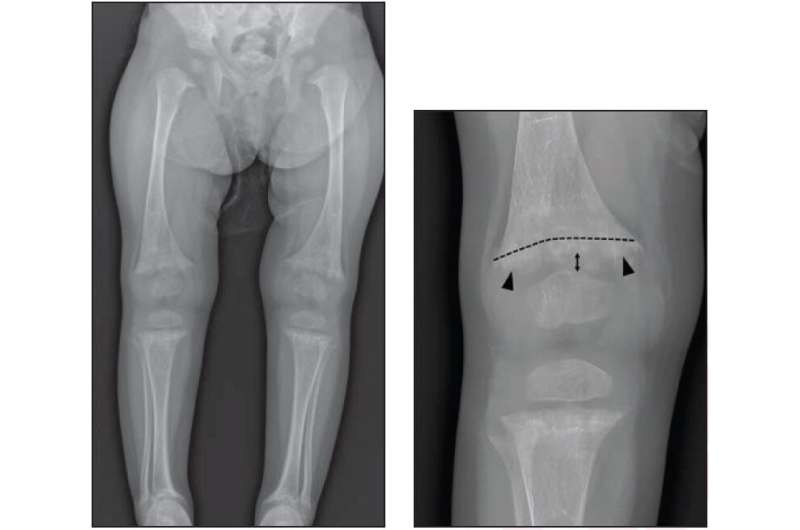 Differentiation of rickets and classic metaphyseal lesions on radiographs