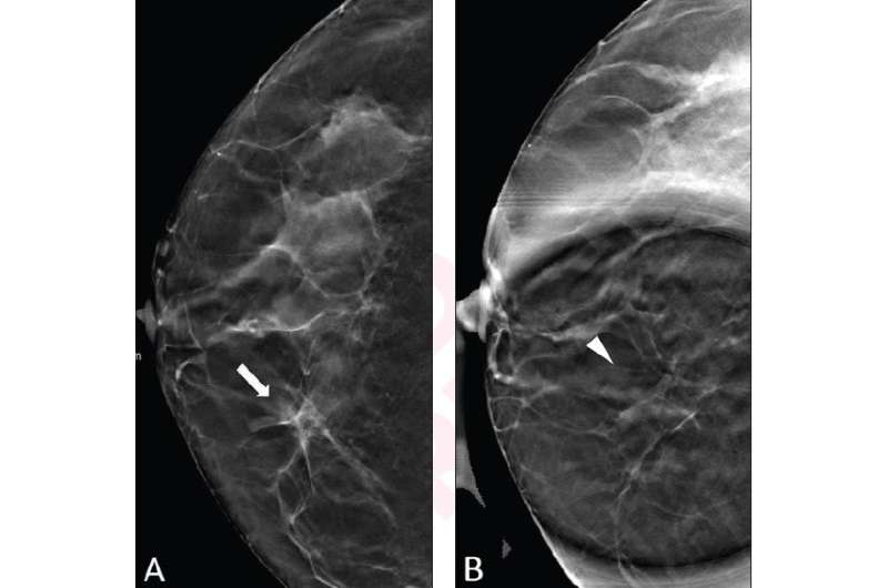Digital breast tomosynthesis spot compression clarifies ambiguous DBT findings