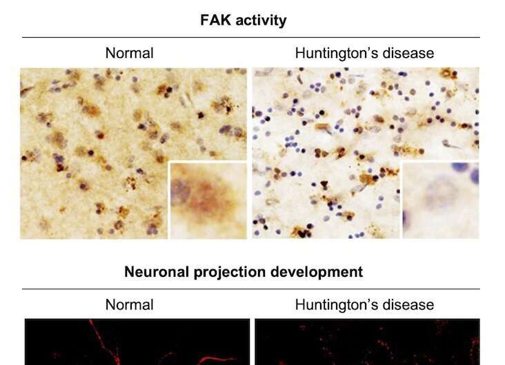 Discovery of the causes of brain dysfunction in patients with Huntington's disease