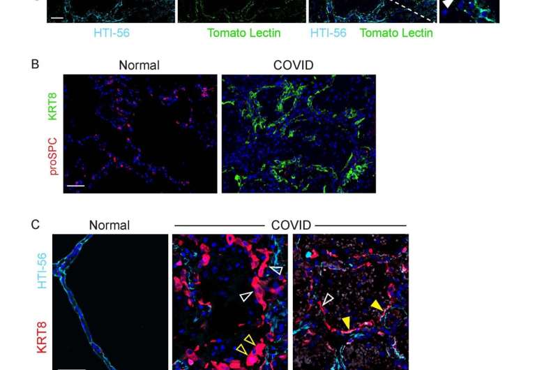 Disruption in lung cell repair may underlie acute respiratory distress syndrome in COVID-19 and other diseases