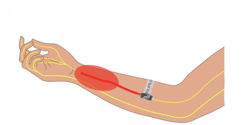 Dissolving implantable device relieves pain without drugs
