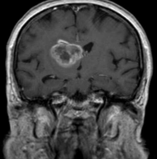 Drug combination that might prove effective for one in three glioblastoma patients