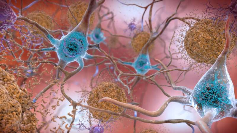 Drug slows Alzheimer's but can it make a real difference?
