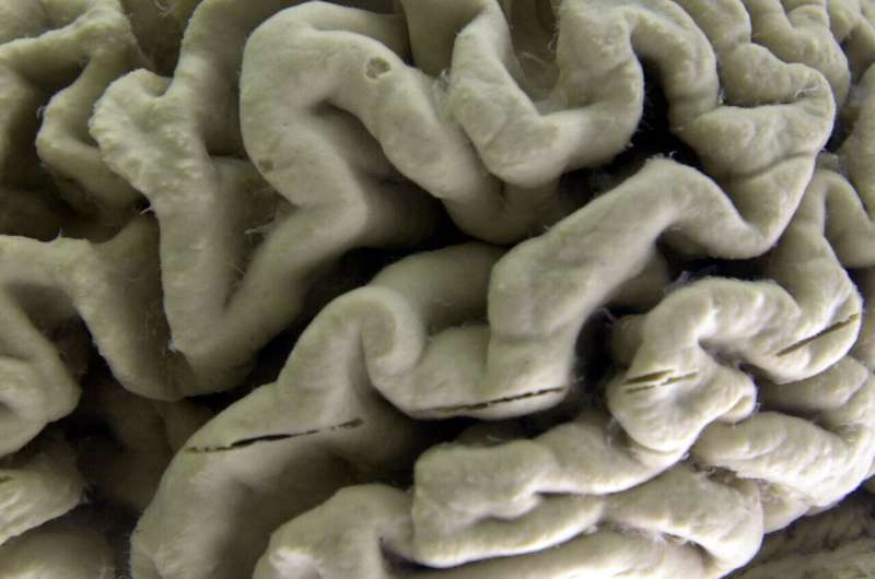 Drug slows Alzheimer's but can it make a real difference?