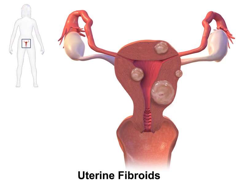 Drug trial shows promise for easing uterine fibroids