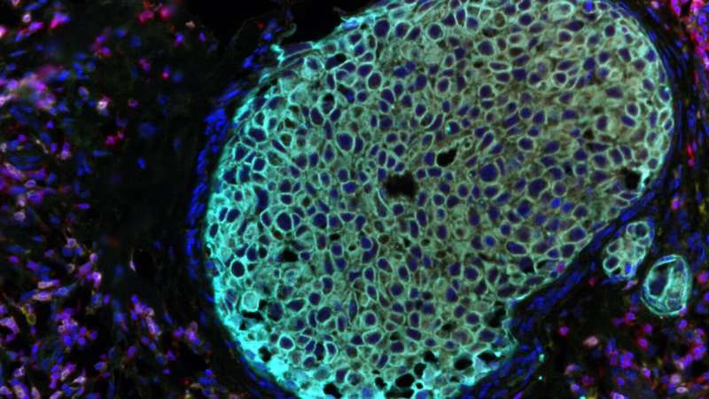 Ductal carcinoma in situ study offers new insights into disease biology, progression