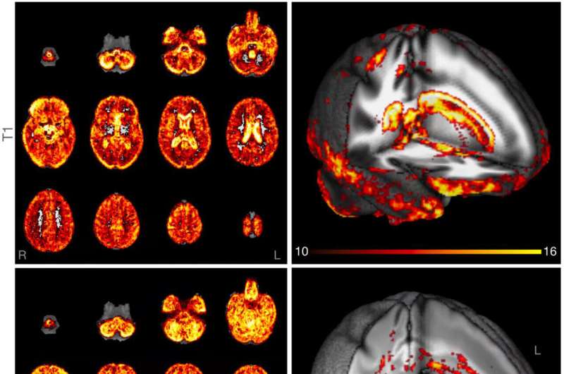 Electronic comparison of MRI brain images accurately determines biological age