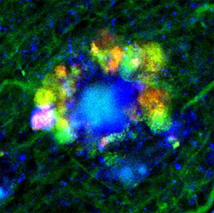 Evidence mounts for alternate origins of Alzheimer's disease plaques