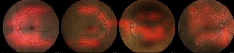 Eye provides clues to insidious vascular disease