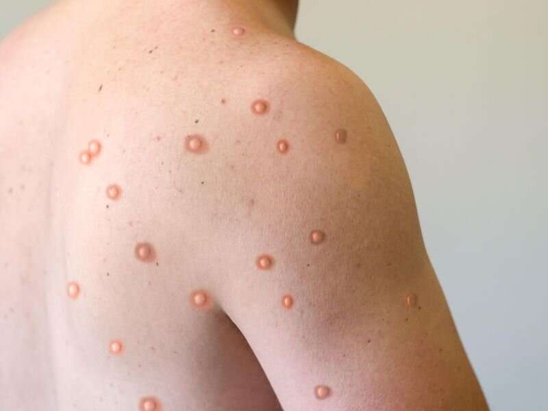 Fewer mpox infection symptoms after vaccination