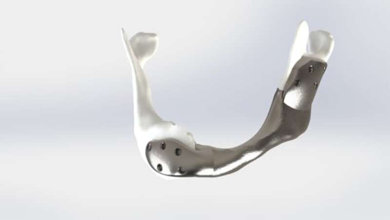 First successful operation with custom 3D-printed titanium lower jaw