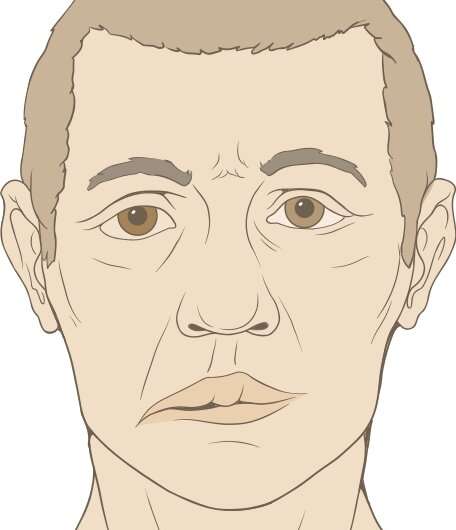 Five facts about Bell's palsy