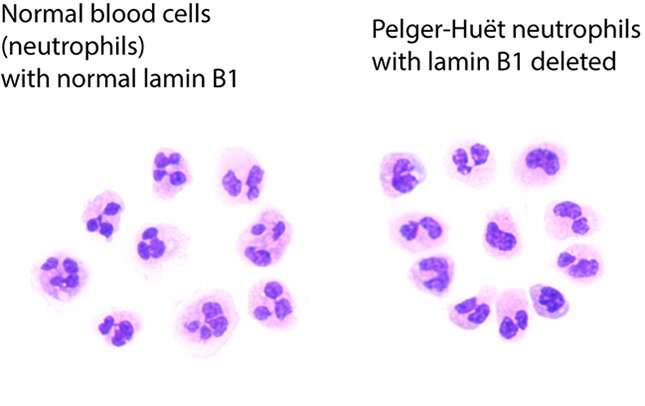 Gene deletion behind anomaly in blood cancer cells