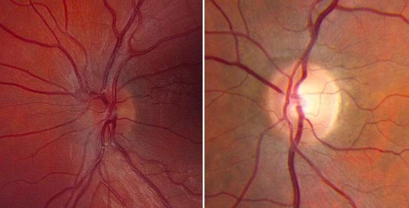 Gene therapy for rare eye disease safe but lacks efficacy in early trial