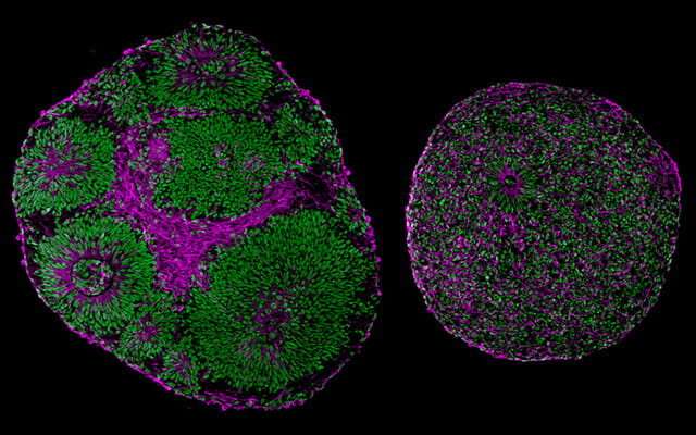 Gene therapy reverses effects of autism-linked mutation in brain organoids