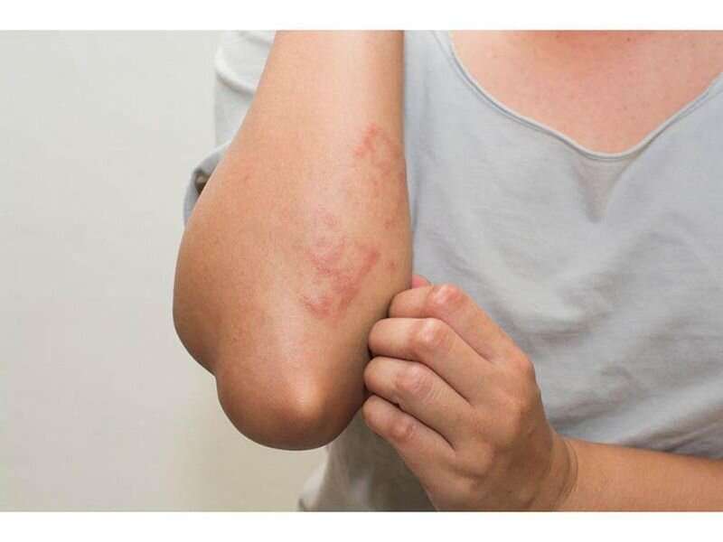 Got hives? How to relieve them at home