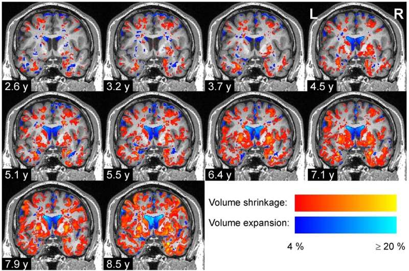 محققان HBP نشان می‌دهند که چگونه حجم نواحی مغز در بیماری پارکینسون تغییر می‌کند